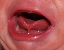 Baby's open mouth showing a band of tissue connected to the floor of the mouth.