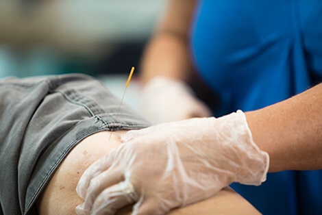 therapist administering dry needling therapy