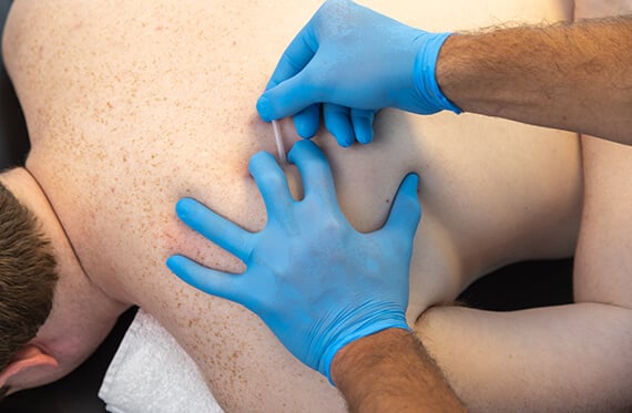 Close up of a patient's back as a therapist places a dry needle on the patient
